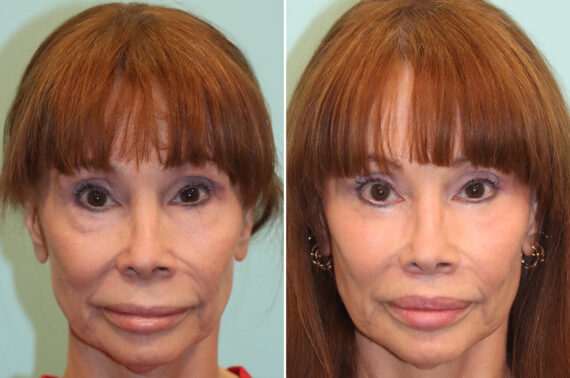Before and after Blepharoplasty by Dr. Shervin Naderi, Patient 41426