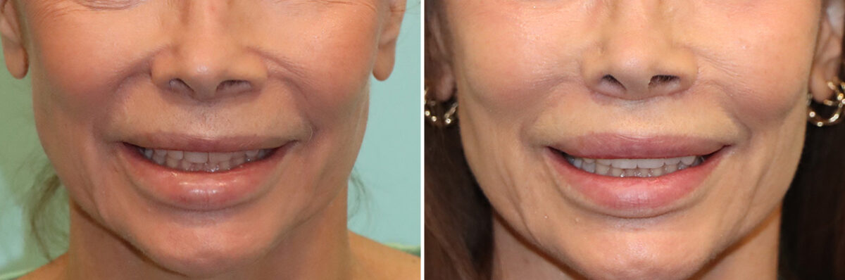 Before and after Lip Lift by Dr. Shervin Naderi, Patient 41429
