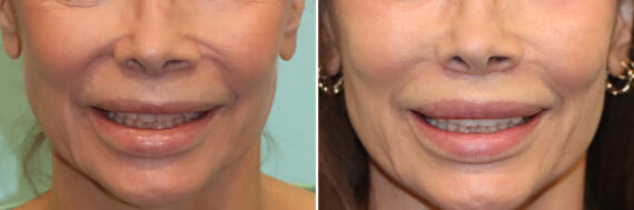 Before and after Lip Lift by Dr. Shervin Naderi, Patient 41429