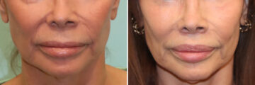 Before and after Lip Lift by Dr. Shervin Naderi, Patient 41429