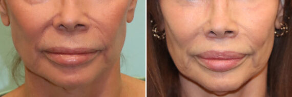 Before and after Lip Lift by Dr. Shervin Naderi, Patient 41429