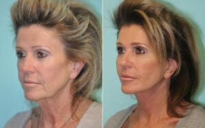 Facelift Recovery Timeline: Realistic Healing Stages