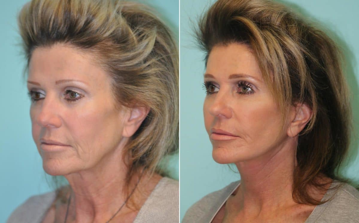 Facelift Before and After Photos Final results