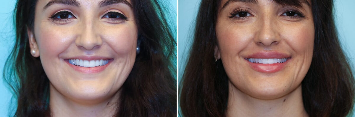 Patient 34918, Lip Augmentation Before and After Photos Before and after Lip Augmentation by Dr. Shervin Naderi, Patient 34918