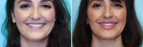 Before and after Lip Augmentation by Dr. Shervin Naderi, Patient 34918