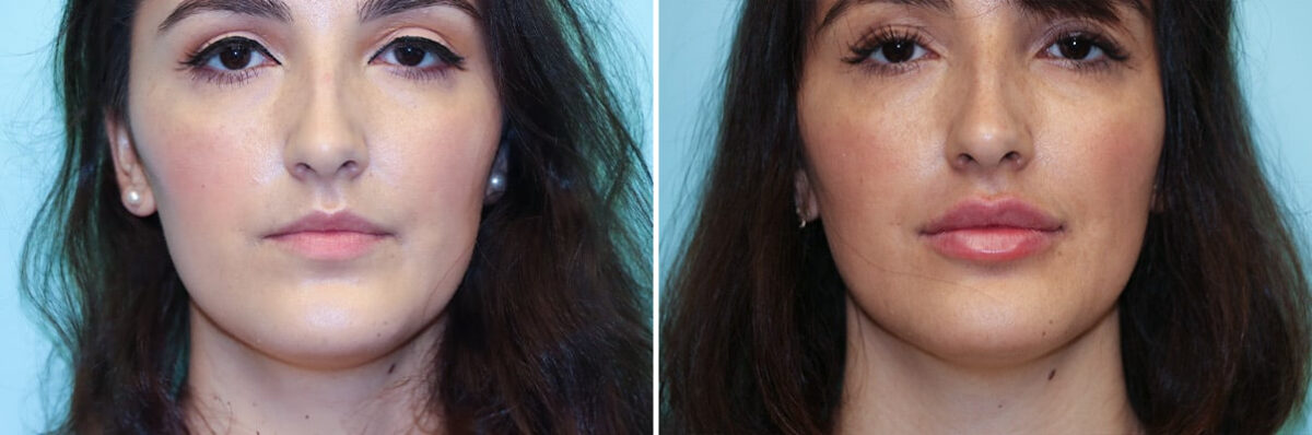 Patient 34918, Lip Augmentation Before and After Photos Before and after Lip Augmentation by Dr. Shervin Naderi, Patient 34918