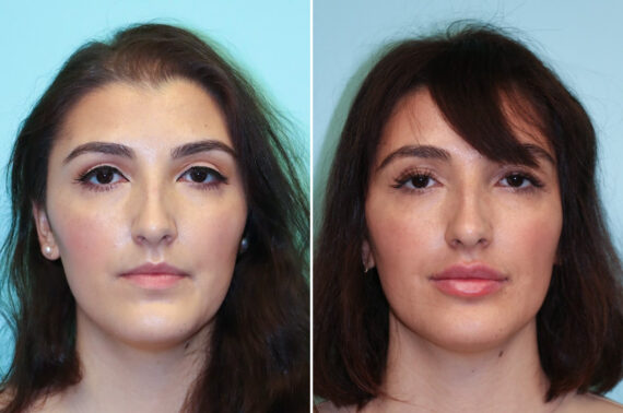 Before and after Lip Augmentation by Dr. Shervin Naderi, Patient 34918