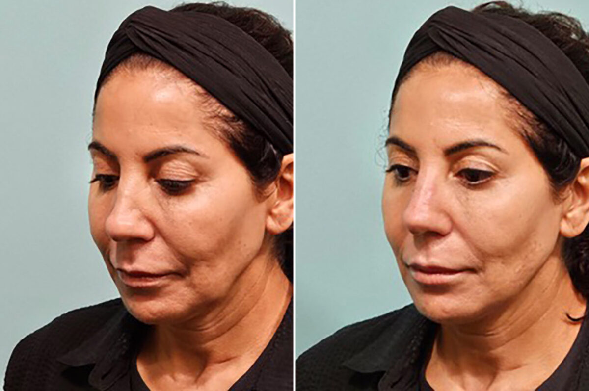 Patient 41906, Non-Surgical Rhinoplasty Before and After Photos Before and after Non-Surgical Rhinoplasty by Dr. Shervin Naderi, Patient 41906