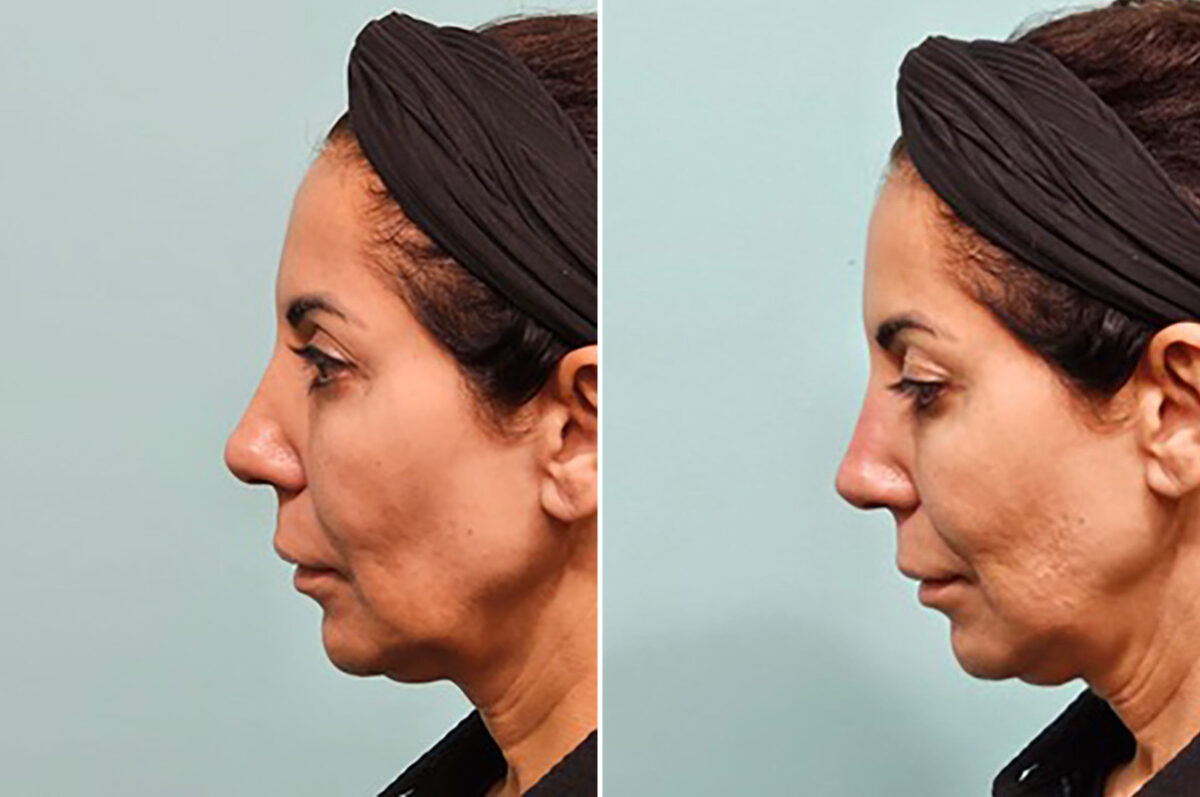 Patient 41906, Non-Surgical Rhinoplasty Before and After Photos Before and after Non-Surgical Rhinoplasty by Dr. Shervin Naderi, Patient 41906