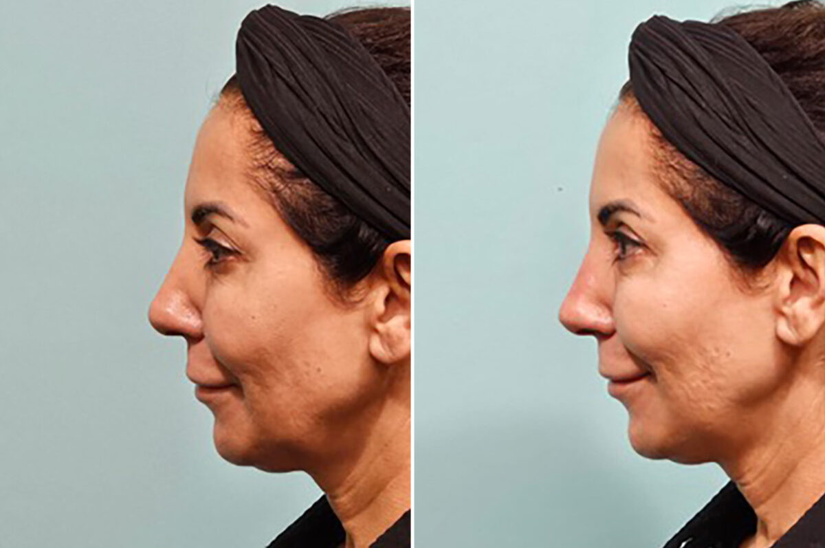 Patient 41906, Non-Surgical Rhinoplasty Before and After Photos Before and after Non-Surgical Rhinoplasty by Dr. Shervin Naderi, Patient 41906