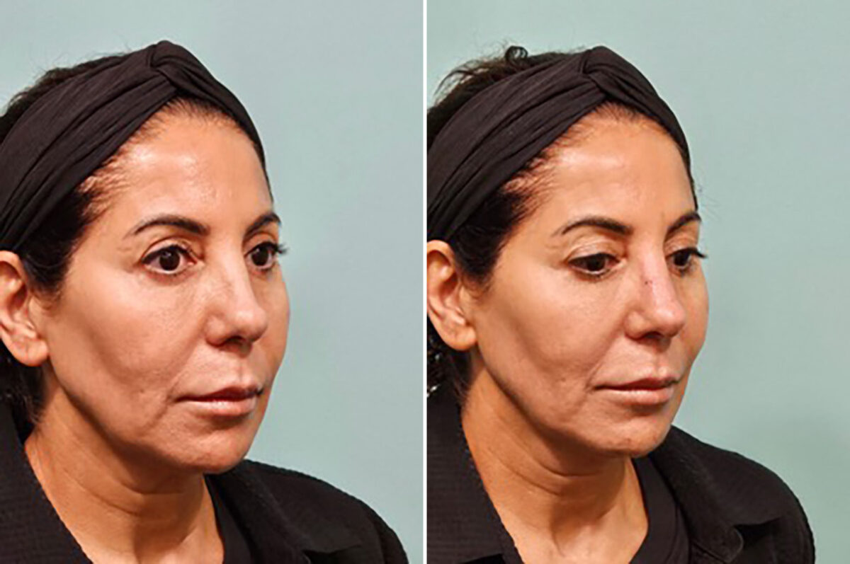 Patient 41906, Non-Surgical Rhinoplasty Before and After Photos Before and after Non-Surgical Rhinoplasty by Dr. Shervin Naderi, Patient 41906