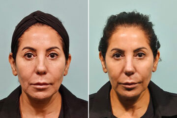 Before and after Non-Surgical Rhinoplasty by Dr. Shervin Naderi, Patient 41906