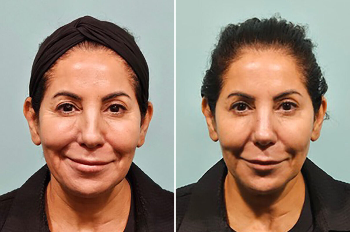 Patient 41906, Non-Surgical Rhinoplasty Before and After Photos Before and after Non-Surgical Rhinoplasty by Dr. Shervin Naderi, Patient 41906