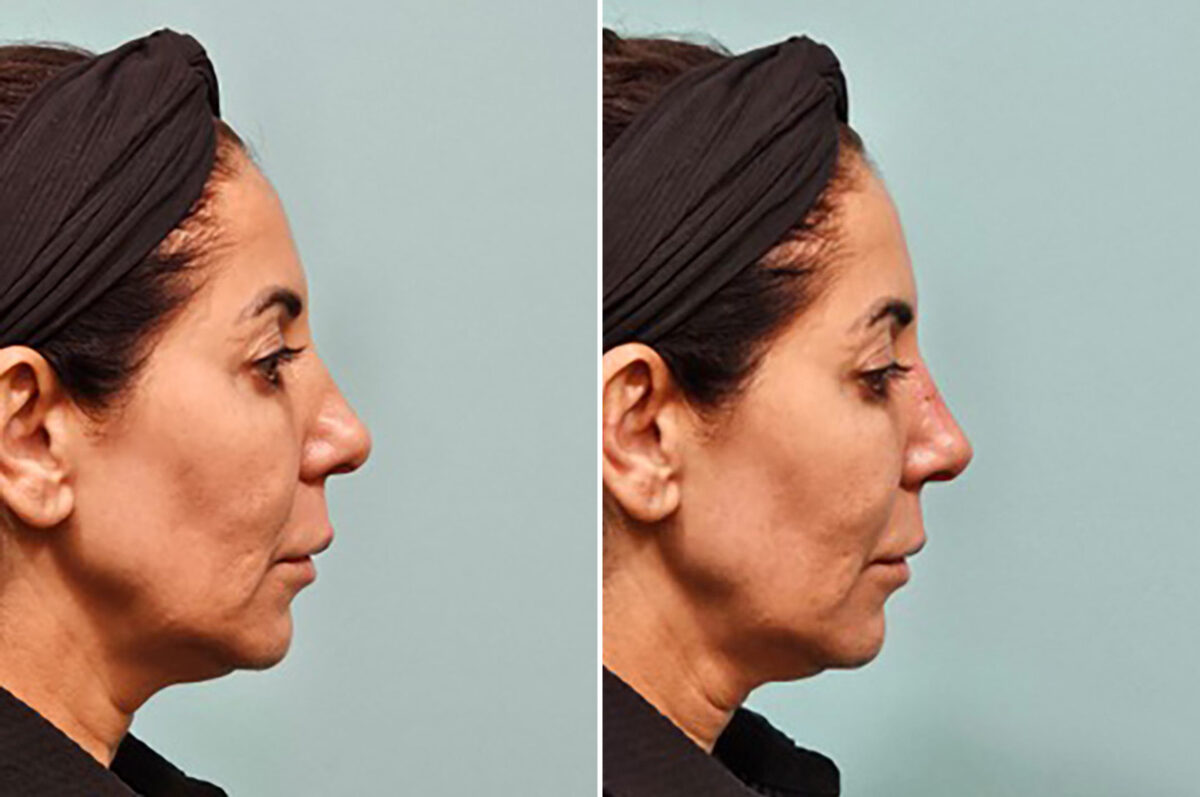 Patient 41906, Non-Surgical Rhinoplasty Before and After Photos Before and after Non-Surgical Rhinoplasty by Dr. Shervin Naderi, Patient 41906