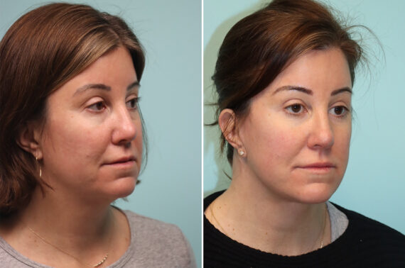 Before and after Facelift by Dr. Shervin Naderi, Patient 41928