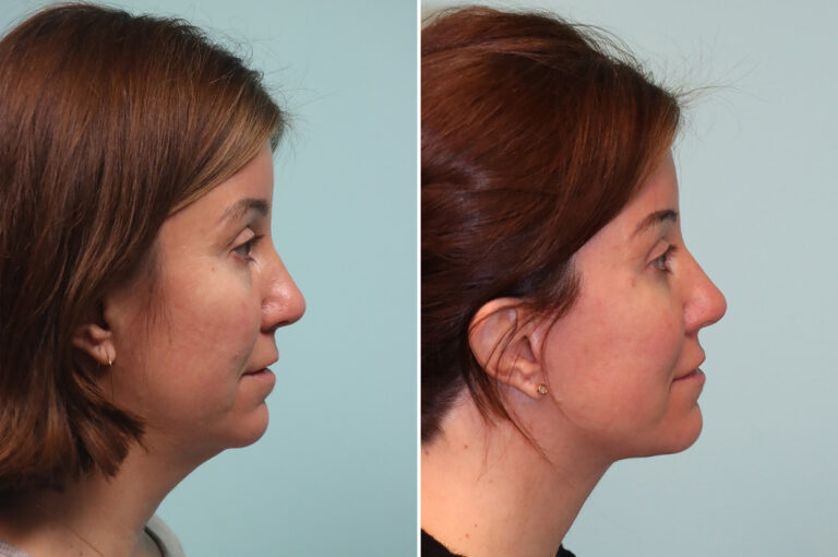 Before and after facelift and neck lift, side profile: a slimmer jawline and a smooth neck