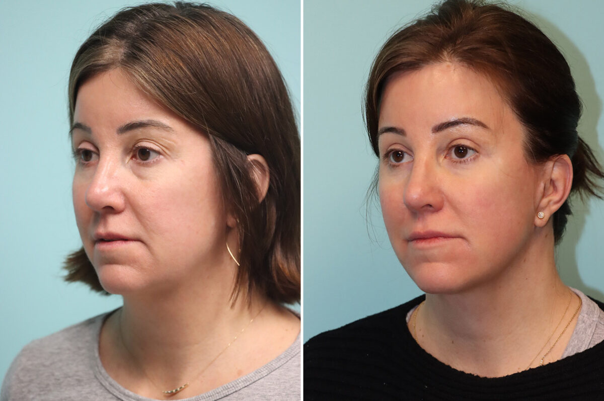 Patient 41928, Facelift Before and After Photos Before and after Facelift by Dr. Shervin Naderi, Patient 41928