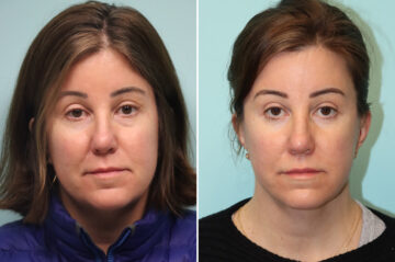 Before and after Facelift by Dr. Shervin Naderi, Patient 41928