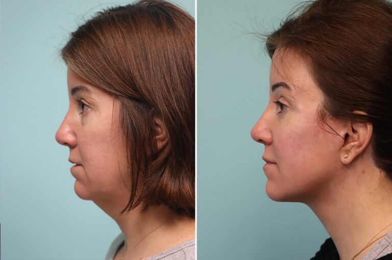 Before and after facelift and neck lift, side profile: a slimmer, more defined jawline
