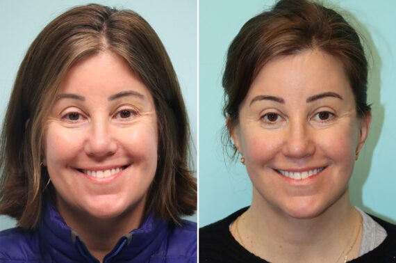 Before and after Blepharoplasty by Dr. Shervin Naderi, Patient 41944