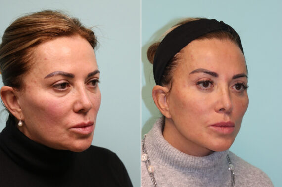 Before and after Blepharoplasty by Dr. Shervin Naderi, Patient 42033
