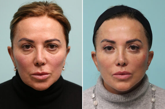 Before and after Blepharoplasty by Dr. Shervin Naderi, Patient 42033