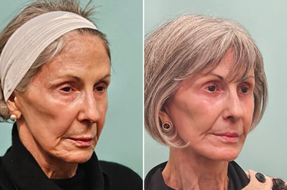 Before and after Facelift by Dr. Shervin Naderi, Patient 42322