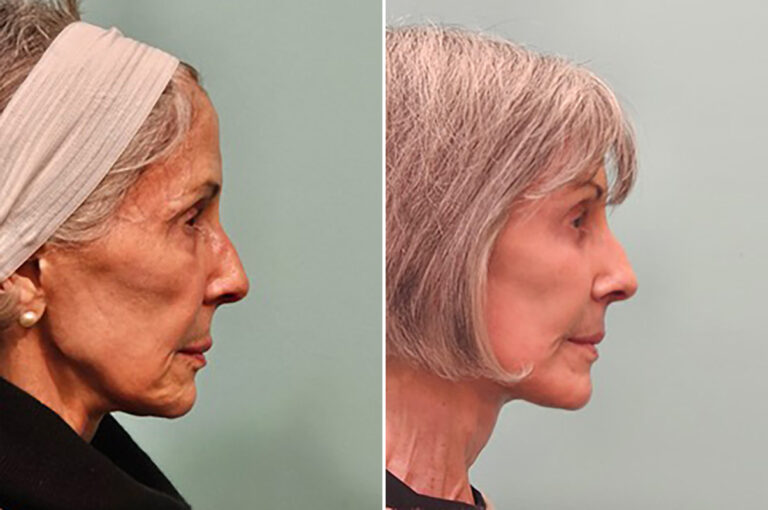 Before and after facelift, side profile: a secondary facelift