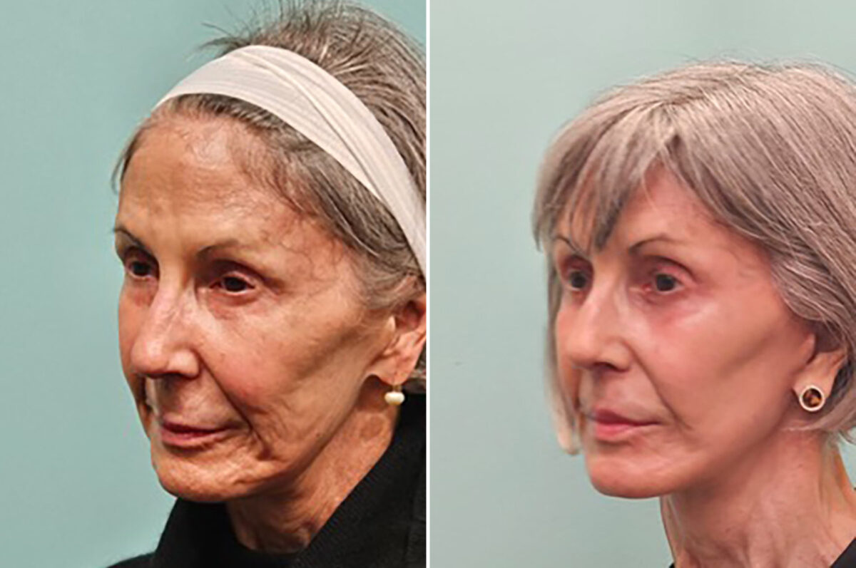Before and after Facelift by Dr. Shervin Naderi, Patient 42322