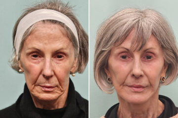 Before and after Facelift by Dr. Shervin Naderi, Patient 42322