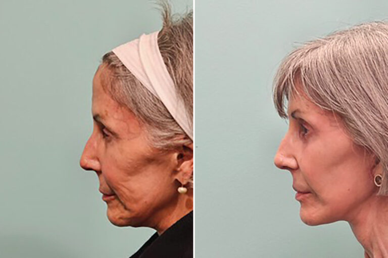 Before and after facelift and neck lift, side profile: a secondary facelift and neck lift