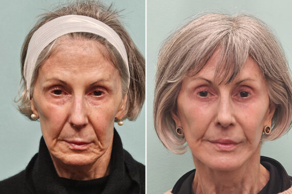 Before and after Facelift by Dr. Shervin Naderi, Patient 42322