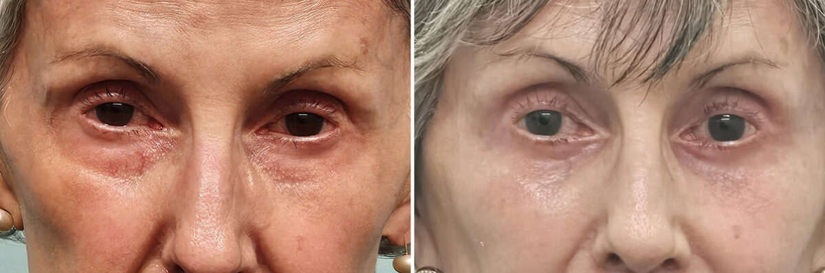 Before and after Blepharoplasty by Dr. Shervin Naderi, Patient 42338