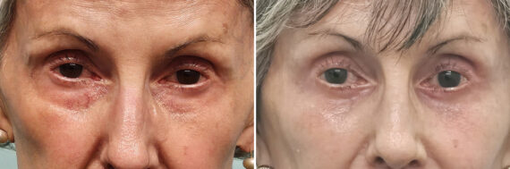Before and after Blepharoplasty by Dr. Shervin Naderi, Patient 42338