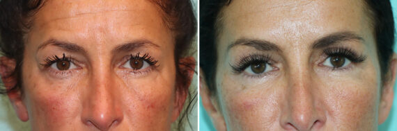 Before and after Blepharoplasty by Dr. Shervin Naderi, Patient 42346