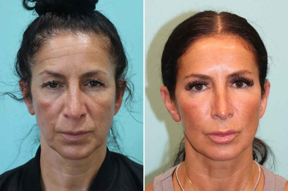 Before and after Blepharoplasty by Dr. Shervin Naderi, Patient 42346
