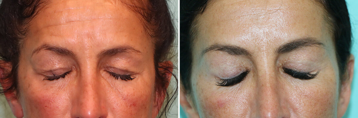 Before and after Blepharoplasty by Dr. Shervin Naderi, Patient 42346