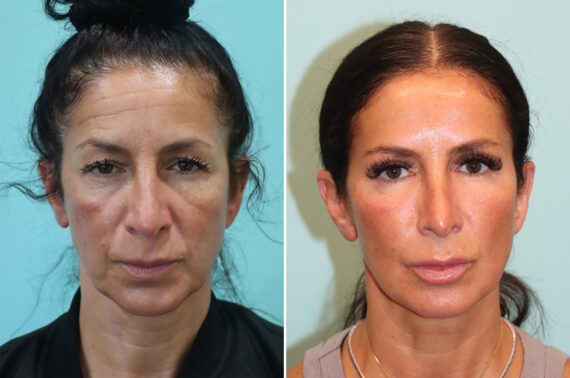 Before and after Blepharoplasty by Dr. Shervin Naderi, Patient 42346