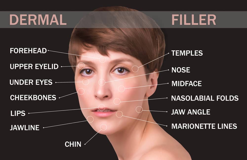 Diagram of woman's face highlighting common dermal filler treatment zones including lips, eyes, chin, and temples