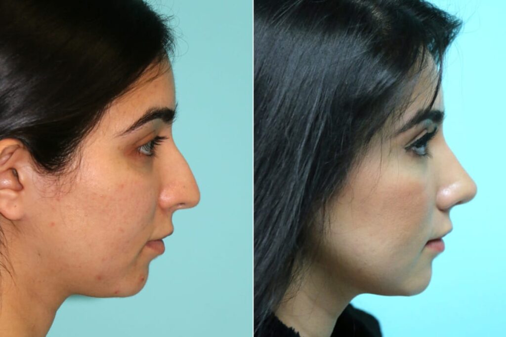 Bulbous Nose Tip Before and After Surgery