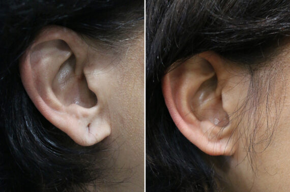 Before and after Ear Lobe Repair by Dr. Shervin Naderi, Patient 42610