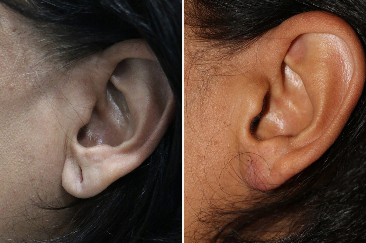 Patient 42610, Ear Lobe Repair Before and After Photos Before and after Ear Lobe Repair by Dr. Shervin Naderi, Patient 42610