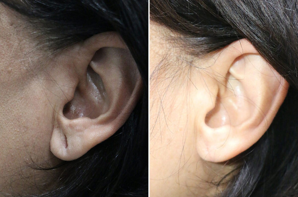 Patient 42610, Ear Lobe Repair Before and After Photos Before and after Ear Lobe Repair by Dr. Shervin Naderi, Patient 42610