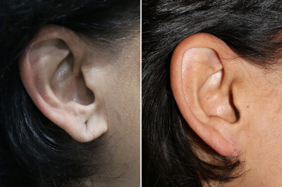 Before and after Ear Lobe Repair by Dr. Shervin Naderi, Patient 42610