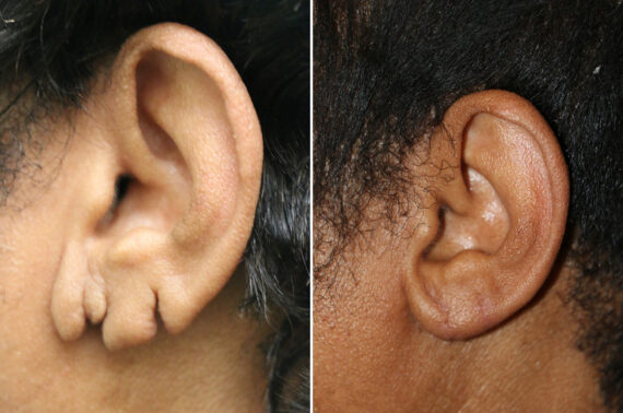 Before and after Ear Lobe Repair by Dr. Shervin Naderi, Patient 42621