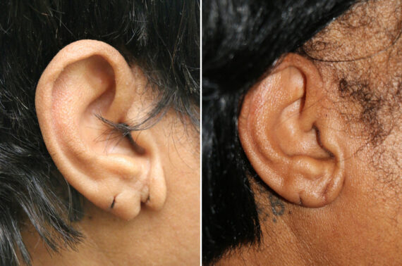Before and after Ear Lobe Repair by Dr. Shervin Naderi, Patient 42621