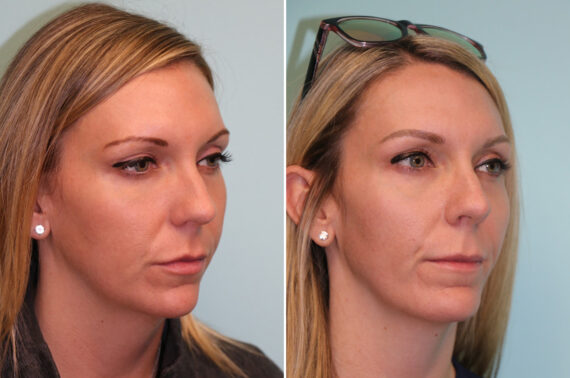 Before and after Chin & Facial Implant by Dr. Shervin Naderi, Patient 42628
