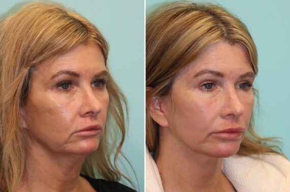 Before and after Facelift by Dr. Shervin Naderi, Patient 42638