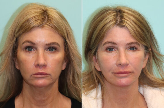 Before and after Facelift by Dr. Shervin Naderi, Patient 42638