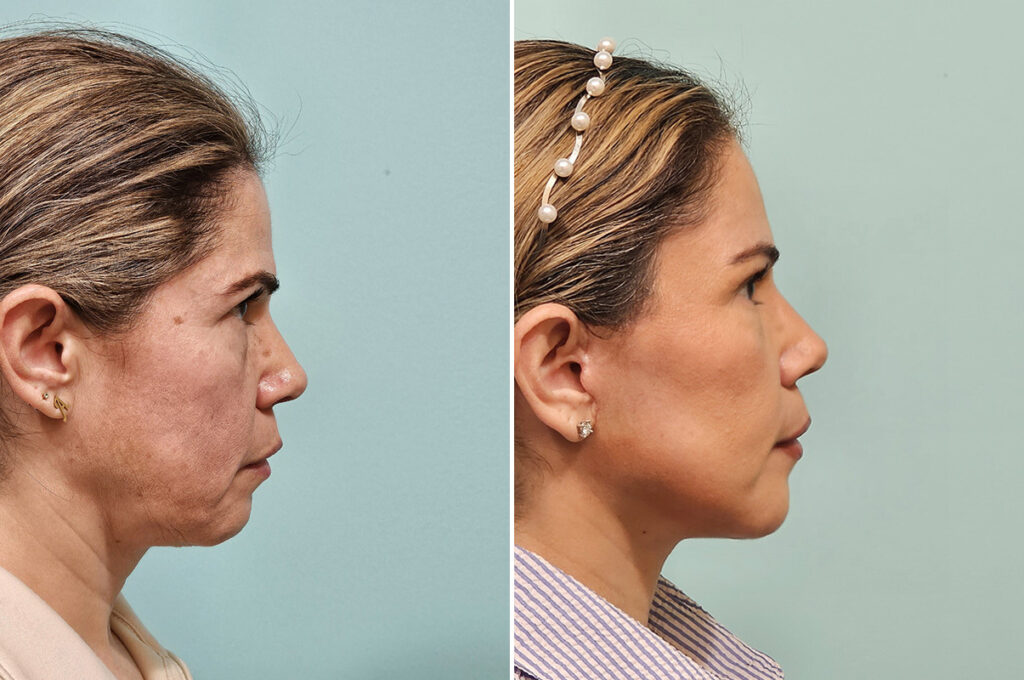 Before-and-after facelift - lateral view
